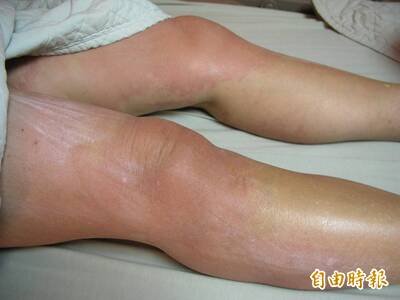 健康網》季節交替蕁麻疹好發 急慢性成因大不同