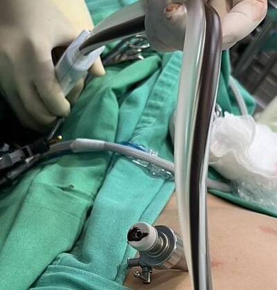 健康網》她兩顆巧克力囊腫長逾10公分 抽出800cc陳年月經血