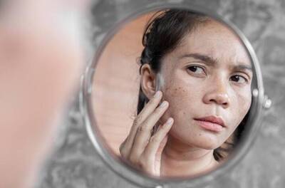 健康網》婦女擔心肝斑上身？ 中醫揭4證型治療方法