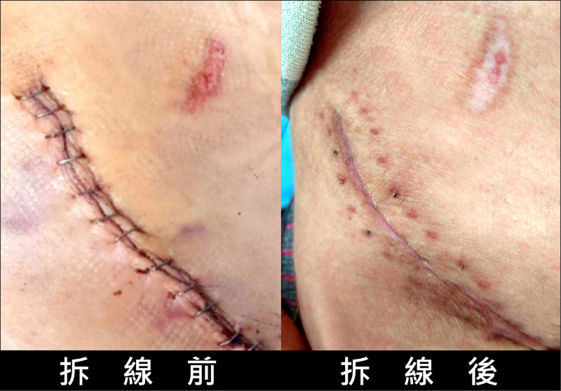 「比基尼線切口術」置換髖關節 美觀恢復快