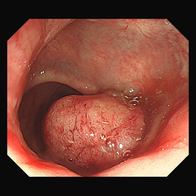 82歲爺爺肛門有大瘜肉誤認痔瘡 肛門微創手術切除