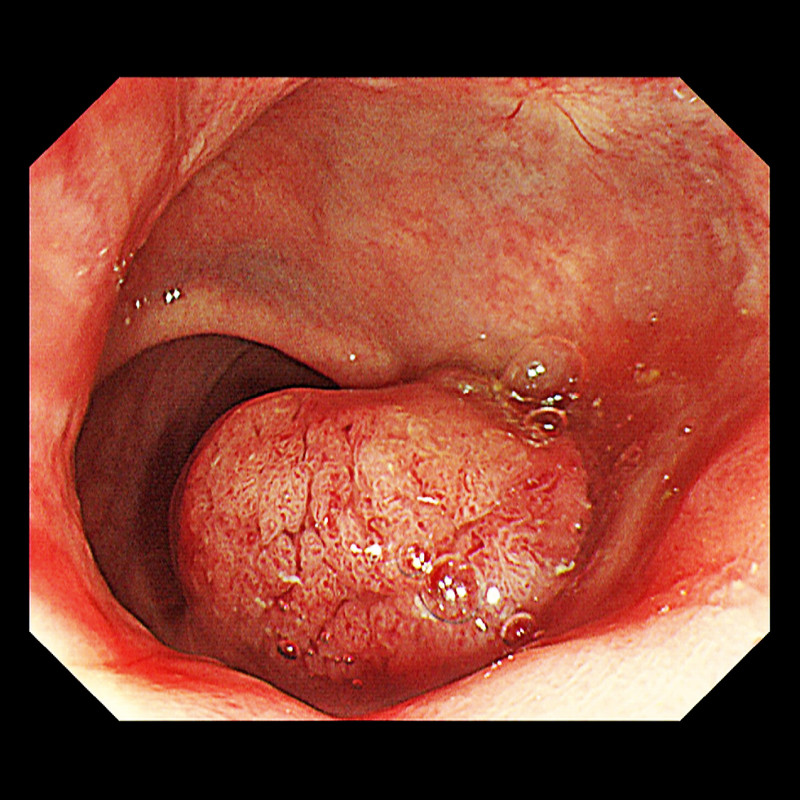 直腸大瘜肉誤認痔瘡 肛門微創手術切除