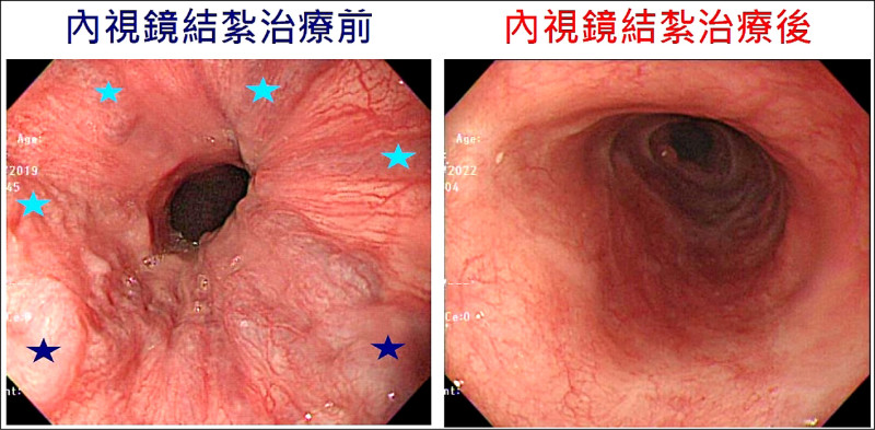 榮總研究登國際期刊》內視鏡結紮減少出血 提高早期肝癌存活率