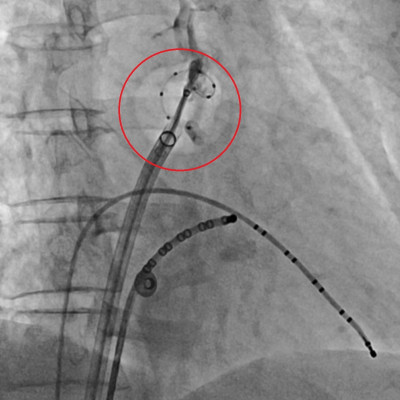 心房顫動恐中風 冷凍氣球肺靜脈隔離術除病灶