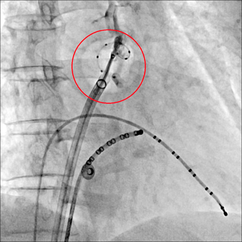 中風機率高5倍 大叔心悸確診心房顫動