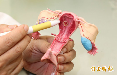 22週胎死腹中 一查原來是「抗磷脂症候群」上身