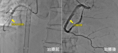 7旬婦看電視突心梗 「心跳停3次」裝葉克膜、支架救命