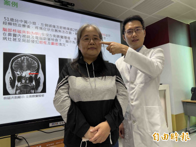 5旬婦單側頭眼痛 一查蝶竇黏液囊腫侵犯眼框及顱底