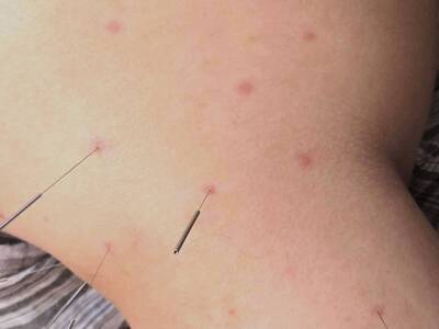 健康網》針灸完起丘疹！ 中醫教你分辨「得氣」還是過敏
