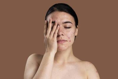 健康網》6種痘痘解析一次看！ 醫：「它」按壓劇痛