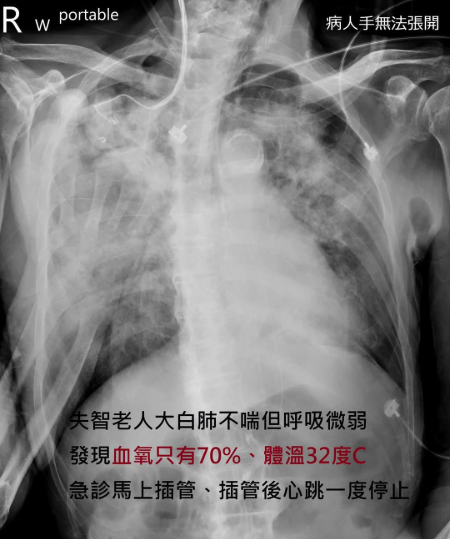 大白肺「不喘的人很多」 醫：缺氧傷害致心跳停止