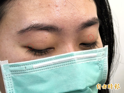 25歲女眼瞼長黃色硬塊 醫一看：快去檢查膽固醇