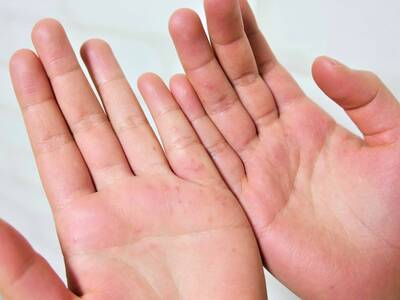 健康網》16歲少女手掌起水泡以為汗疱疹 一驗二期梅毒