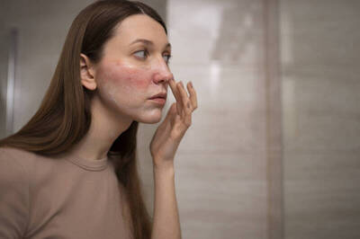 健康網》中醫治臉部脫屑！ 3證型紫雲、黃連膏外用調理