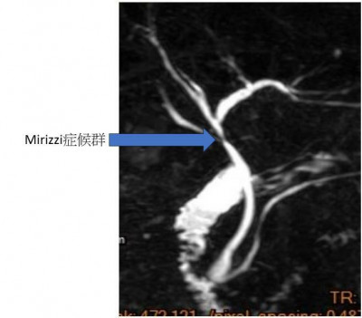 腹痛臉黃好痛苦！擔心膽道阻塞 3D微創幫大忙