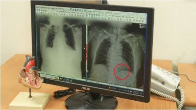 心臟跳不動險昏厥！「微型心臟電池」 助九旬翁恢復心律