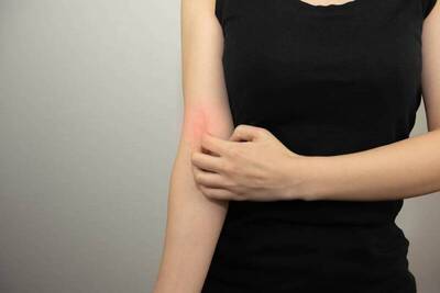 健康網》春季皮癢好惱人！ 中醫教3招舒緩「疹」狀