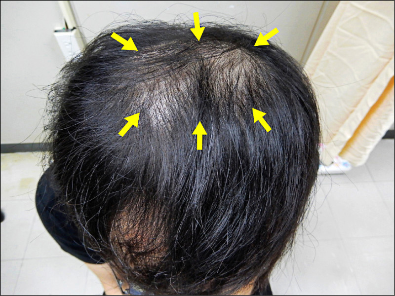 掉髮未必雄性禿 竟是「梅毒」惹禍