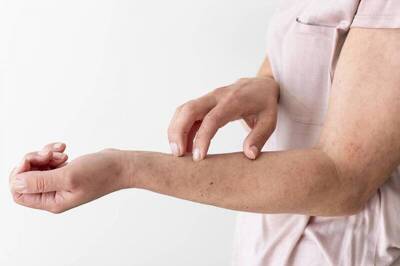 健康網》麻疹病例雙北現蹤 感染者紅疹前症狀似感冒