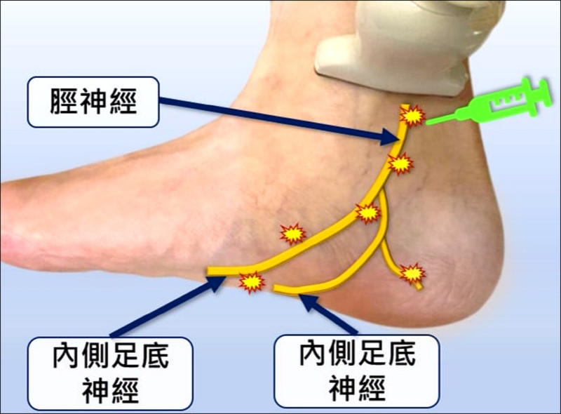 小腿骨折癒合 脛神經壓迫痛到腳底