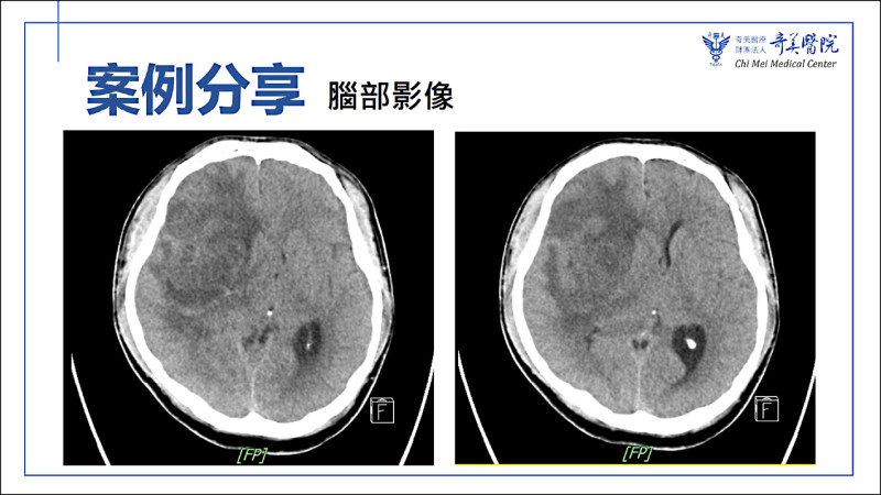 大叔手麻痛、聞「汽油味」竟是癲癇前兆