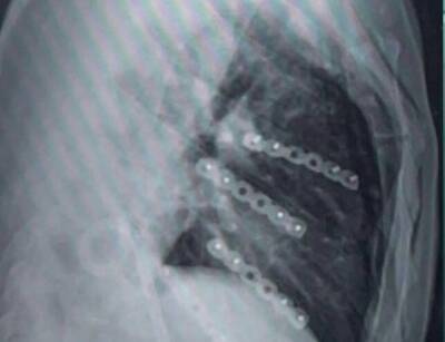 因車禍造成右側肋骨連枷胸  透過連枷胸達文西手術縮小傷口