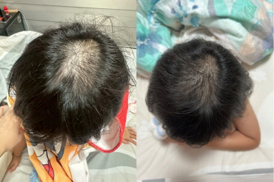 過度消毒恐有風險！ 香港研究：疫情寶寶過敏發病率增