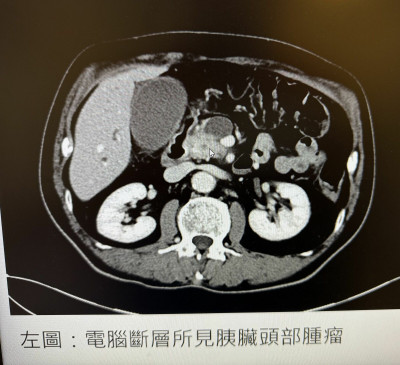 近7旬婦皮膚黃疸、深茶色尿 檢查赫見胰臟癌瘤