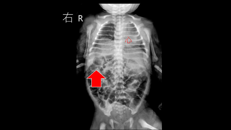 嬰「異位症候群」 肝在左胃在右