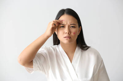 健康網》夏日4大戰痘攻略 告別夏日油光