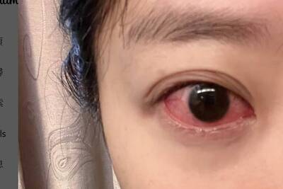 健康網》洪詩追劇哭致眼角膜糜爛 醫：角膜太乾了