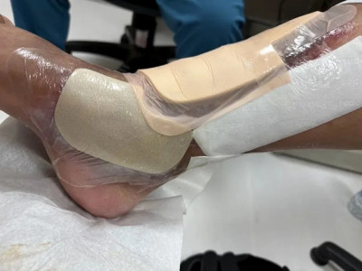 反覆治靜脈曲張卻潰瘍不癒 醫示警:恐心肺衰竭