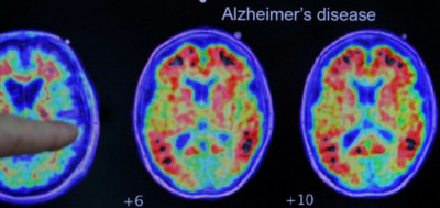 罪魁禍首是它？美研究：星形膠質細胞產生ROS 恐失智症關鍵