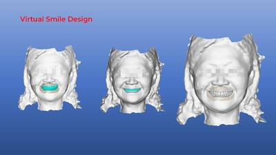 健康網》3D+AI客製假牙 醫：減少就診次數、時間