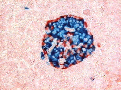 為何第1型糖尿病 對兒童更具侵襲性？英國研究有答案