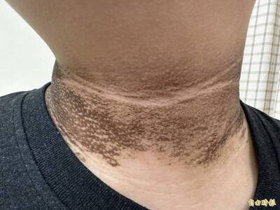 健康網》脖子黑&ne;沒洗乾淨 黑色棘皮症上身啦！