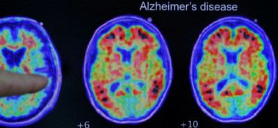 阿茲海默症新希望 科學家揭示微膠質細胞可保護大腦