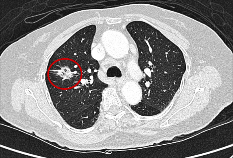 光子刀治療肺腺癌 83歲嬤追蹤5年未復發