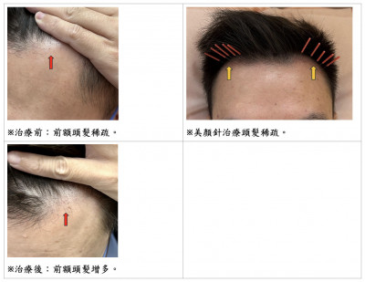 M型禿怎麼辦？北市聯醫推「美顏針」減緩掉髮