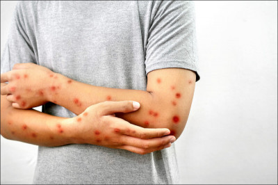 英國現M痘新變種！患者有亞洲旅遊史 病毒竟是兩大分支「混合體」