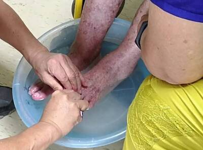 健康網》被足底疣纏上 醫授好用泡腳法須有耐心