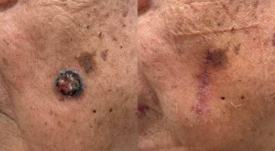 8旬翁臉上黑痣變大潰瘍 皮膚基底細胞癌上身