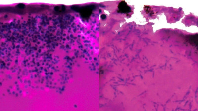 致死率45％！ICU殺手「耳念珠菌」難滅 專家發現剋星線索