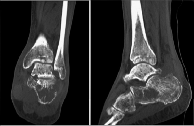 全球第5例》8旬翁足跟腫痛治不好 竟是極罕見「跟骨多發性骨髓瘤 」
