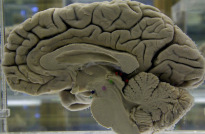 研究顯示微小基因突變 可能終生影響大腦發育