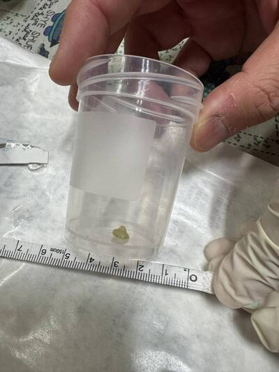 健康網》芭樂噎童送ICU  醫：幼童4歲前別碰堅果類、湯圓等食物