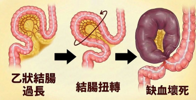7旬翁腹脹、腹痛1週未排便 大腸打結險喪命