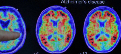 研究發現刺激特定受體 有望提升大腦對阿茲海默症防禦能力