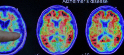 研究：重置生理時鐘 可能有助抗阿茲海默症
