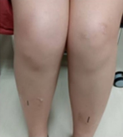 妙齡女首騎飛輪尿變茶色 引發急性橫紋肌溶解症